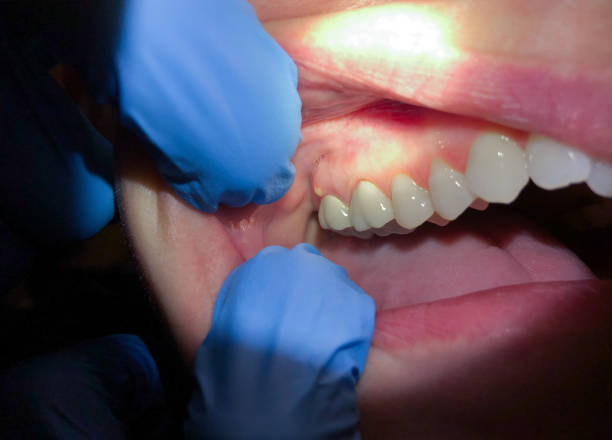 Best Emergency Dental Care for Abscessed Tooth in Stratford Downtown, CT